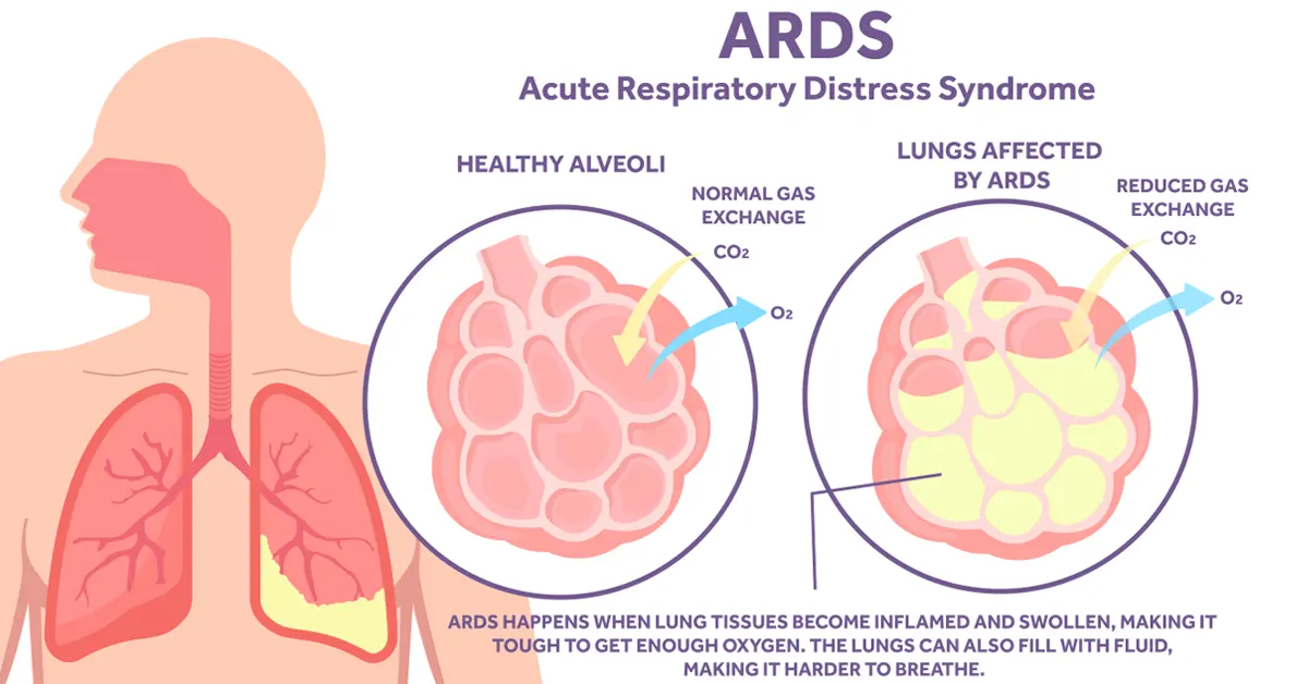 Infographic of the effects ARDS has on the lungs